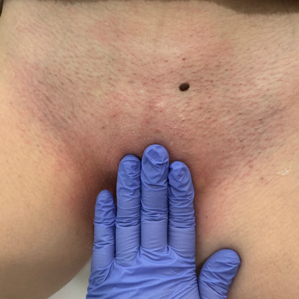 Brazilian touch-up at Chauntelles aesthetics in Bangor, ME