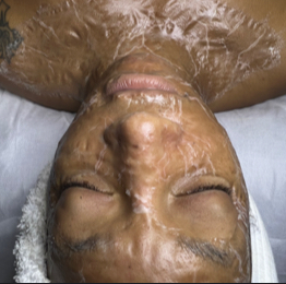 Oxygen-Enzyme Chemical Peel Facial