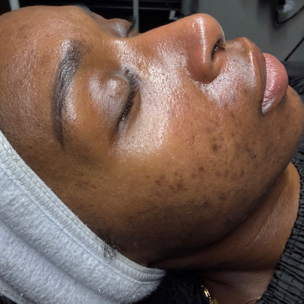 Custom Corrective Facial (Anyone) at Radiant Eyes & Aesthetics in Petal, MS