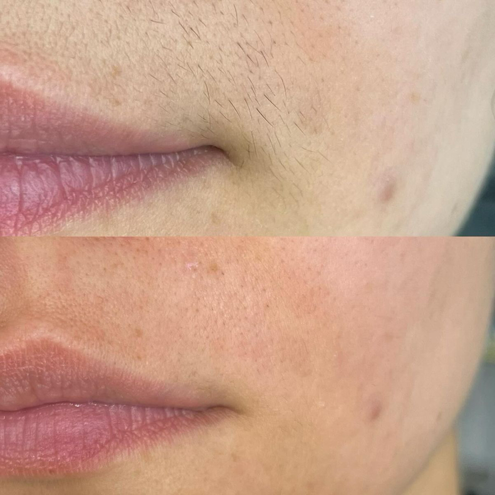 Upper / Lower Lip Wax at LauLux Esthetics in Bellerose, NY
