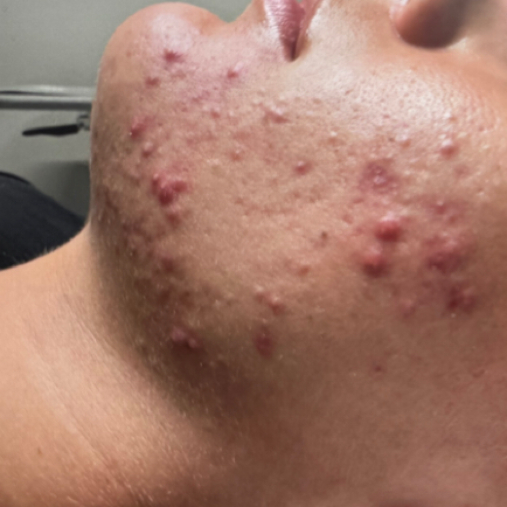Acne Program After Consultation at Beauty Zone by Tetiana Cherepaka in Chicago, IL