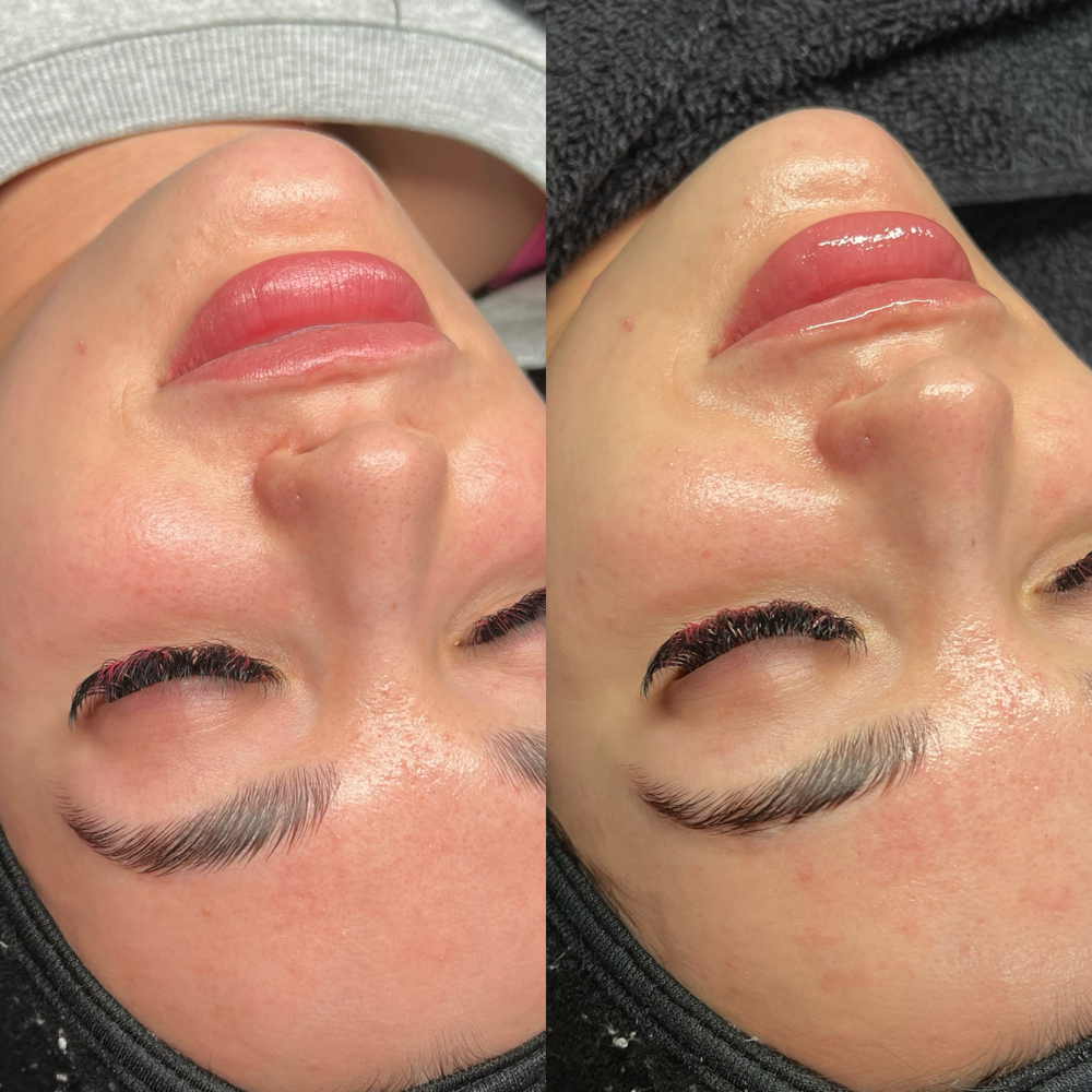 Year of HydroGlo’s at Skin Therapy in Golden valley, MN