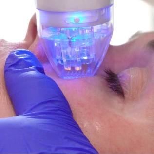 VIVACE Microneedling Face