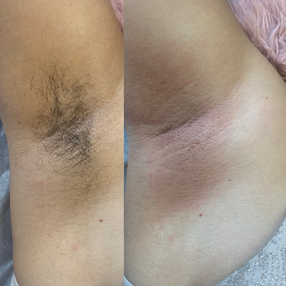 Underarms at Beauty Glow in Columbia, MO