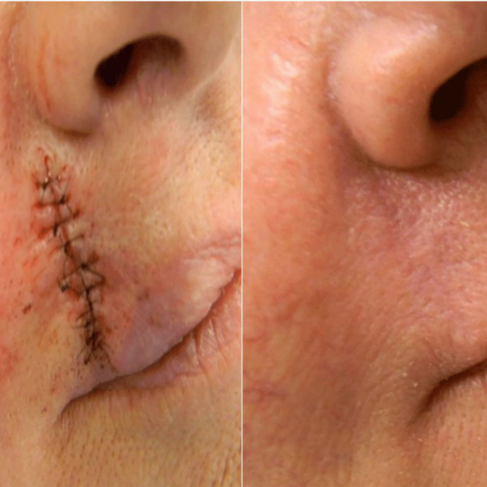 SkinPen Scar Remover at Zen Beauty in McAllen, TX