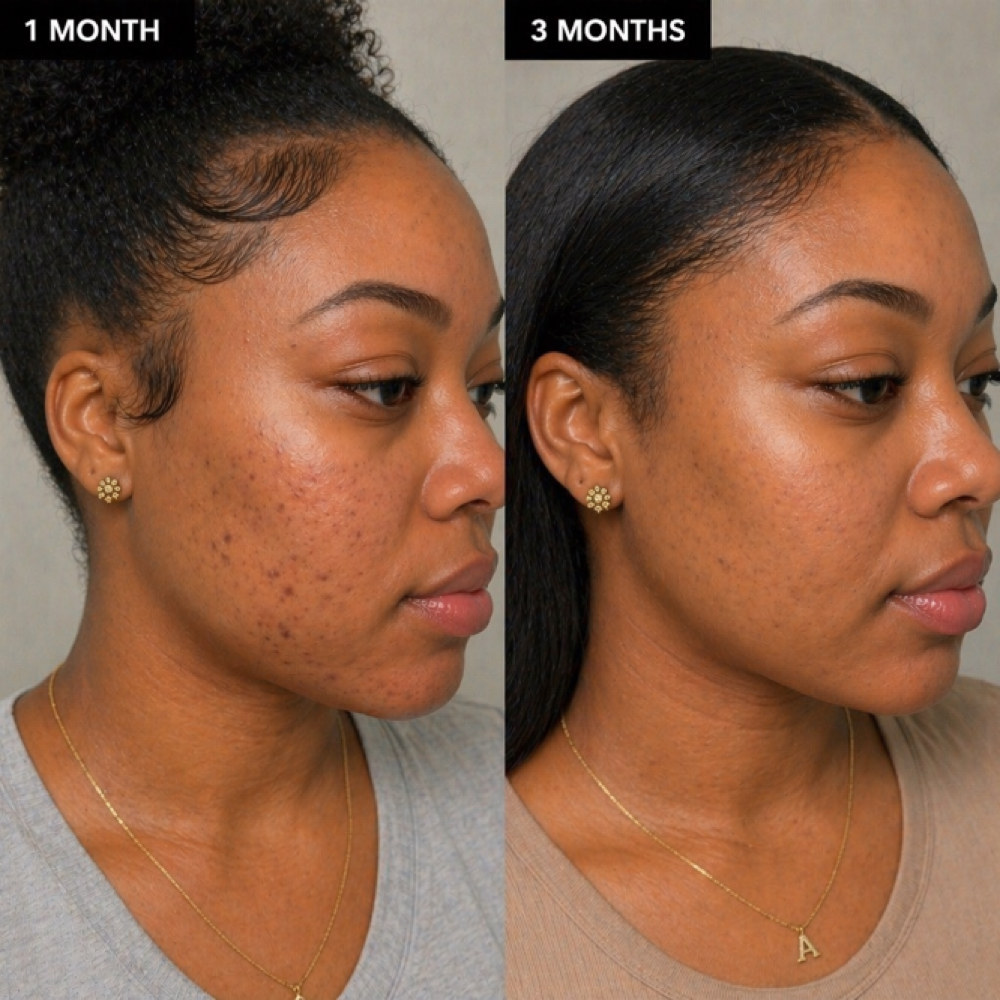 Acne + PIH Reset at EHT Spa in Valdosta, GA