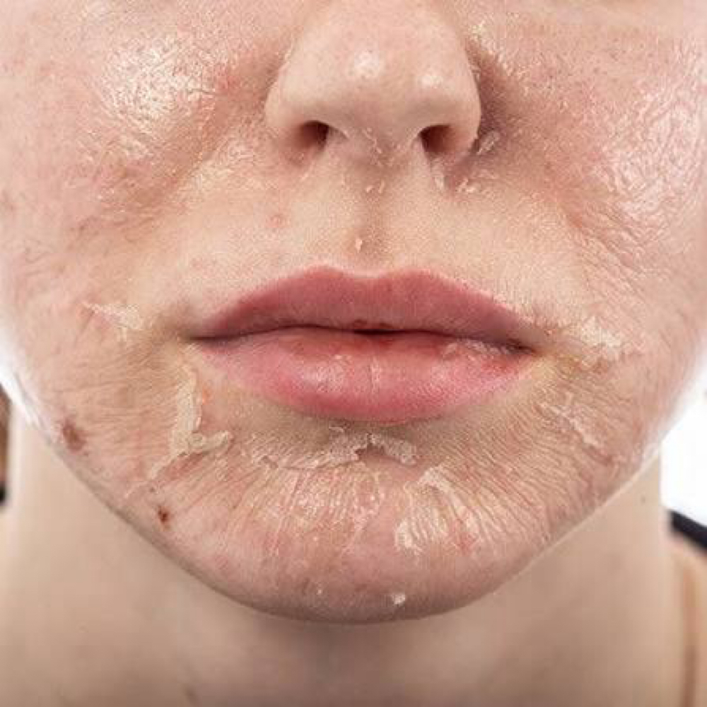 AcneRx Peel at Haus of Beauty Studio in Hialeah, FL