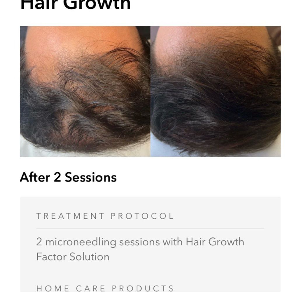 Hair Microneedle growth Factors at L A BEAUTY STUDIO in Lakeway, TX