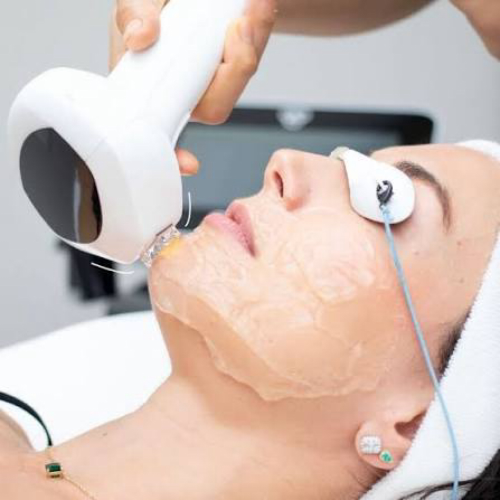 IPL Face + Neck at Luxe Level Aesthetics in Darien, CT