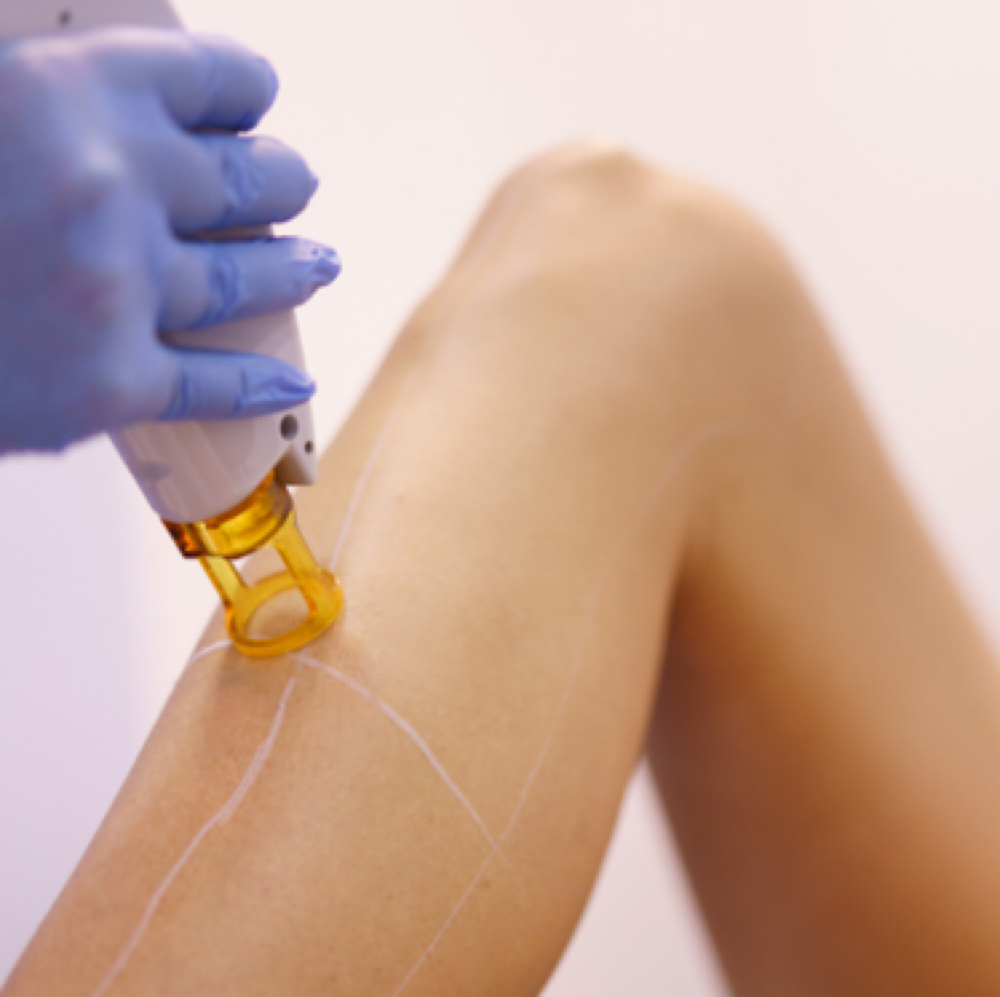 Laser Hair Reduction- Half Legs at Joy to Beauty in Jupiter, FL