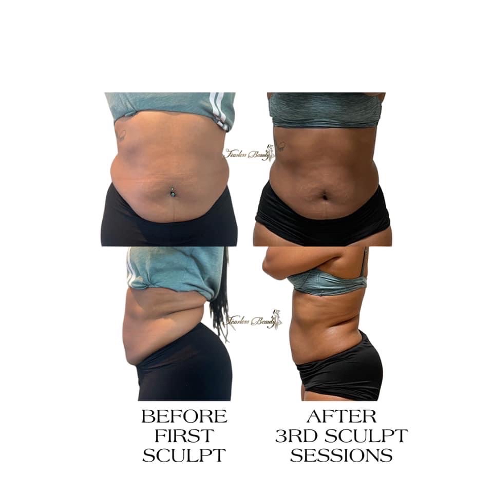 The “SCULPT” Body Sculpting