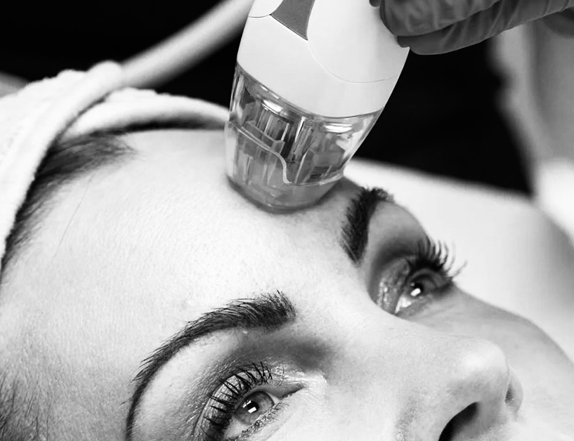 RF Microneedling