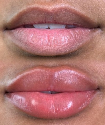 Lips Neutralization