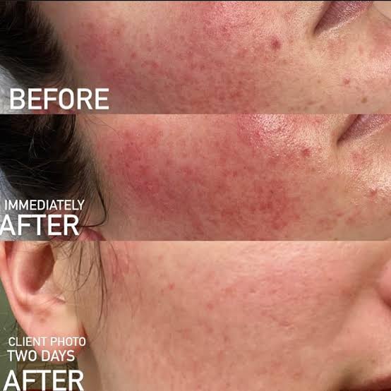 Her. Reset facial & Chemical Peel