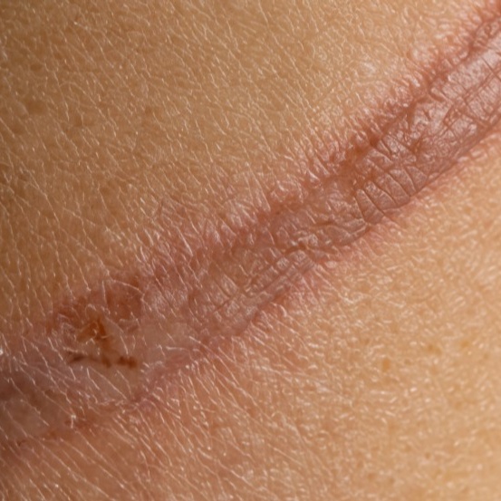 SCAR REMOVAL (SMALL) PKG OF 3 at WilKay Wellness & Aesthetics in Gilbert, AZ