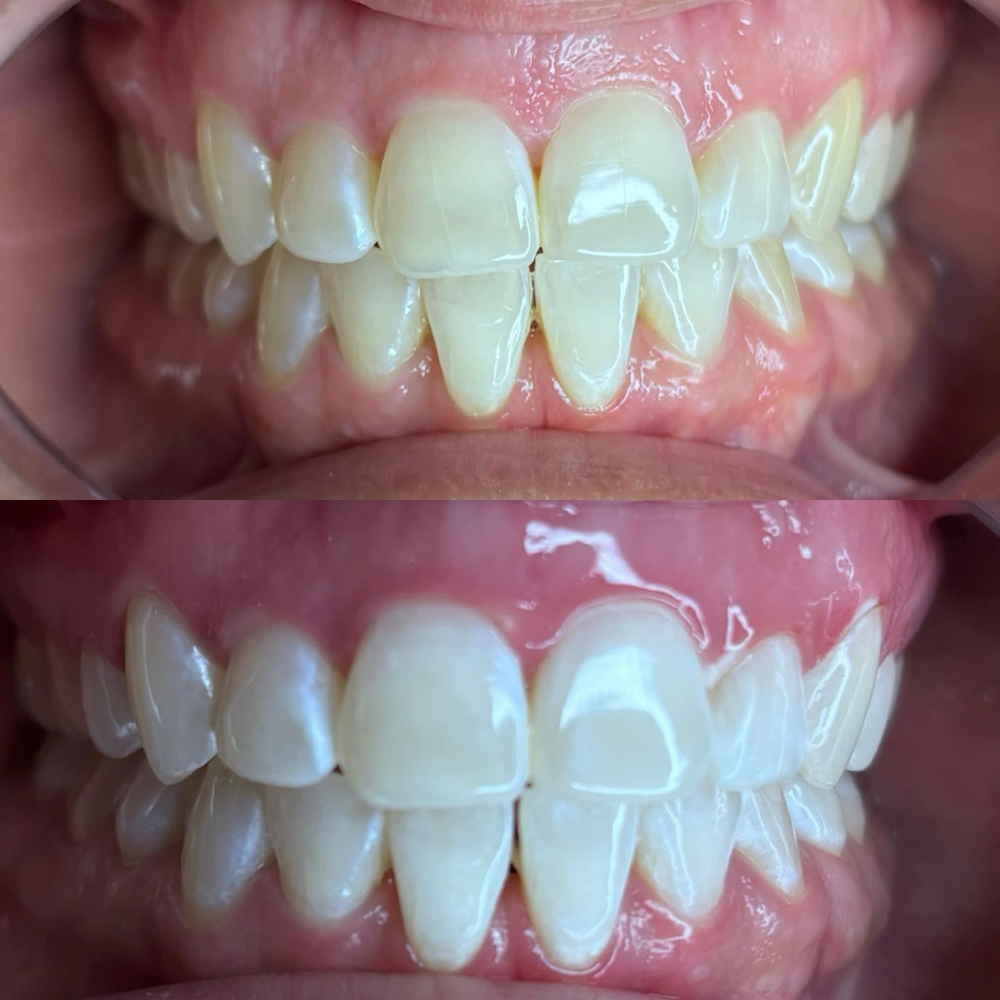 Teeth Whitening 30 Minutes