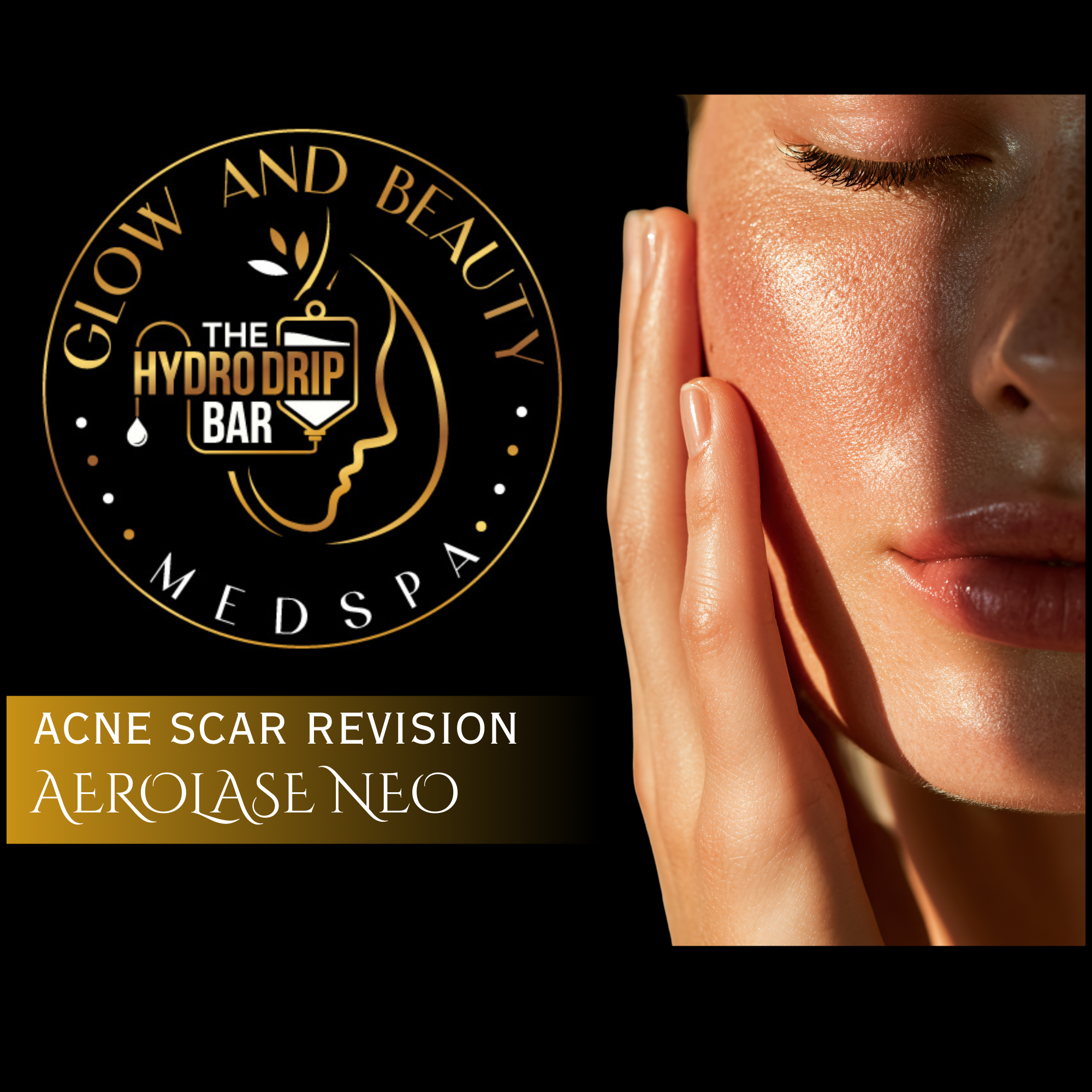Acne Scar Revision - Aerolase Neo