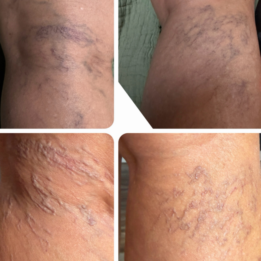 Leg Vein Treatments (sclerotherapy) at Southern Sparkle Medical Aesthetics in Swainsboro, GA