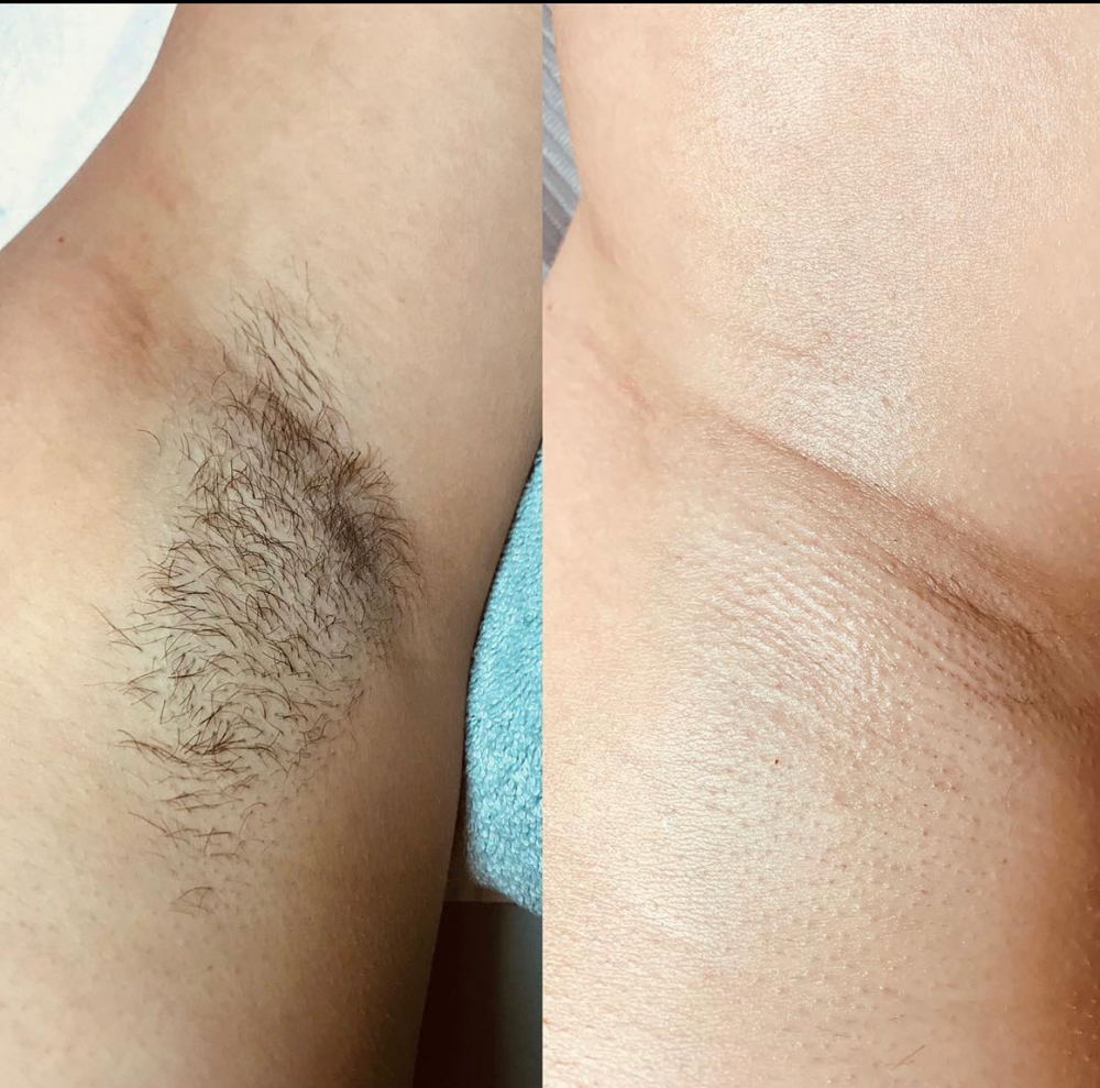 Waxing/ Hair removal