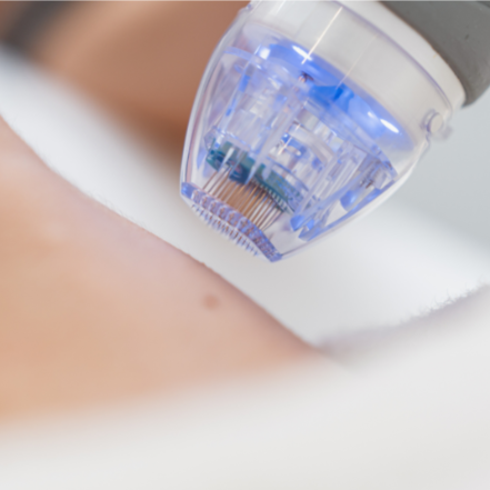 Microneeding with PRP Injected at DM Laser Skin Care Solutions in Needham, MA