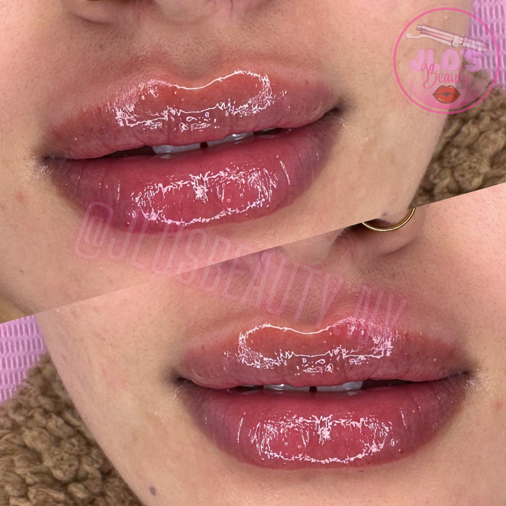 Hyaluron Lip Fillers