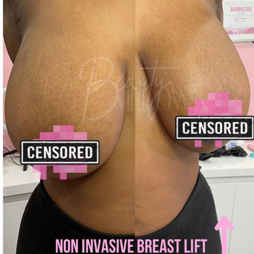 BREAST LIFT at Esthiology Skin Lab in Nottingham, MD
