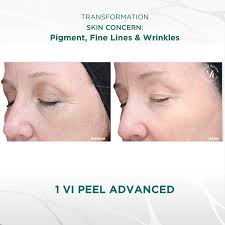 Advanced VI Peel!