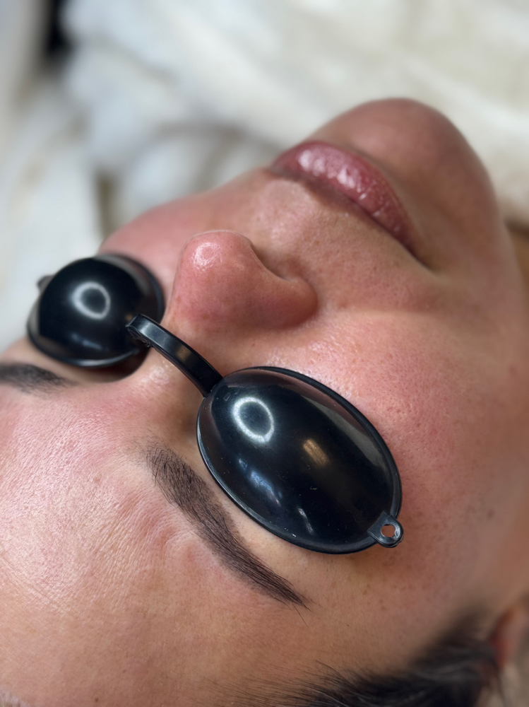 Lactobionic Peel