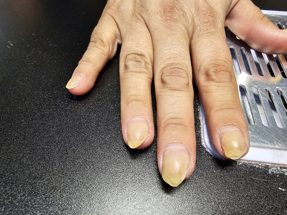 Nail Repair