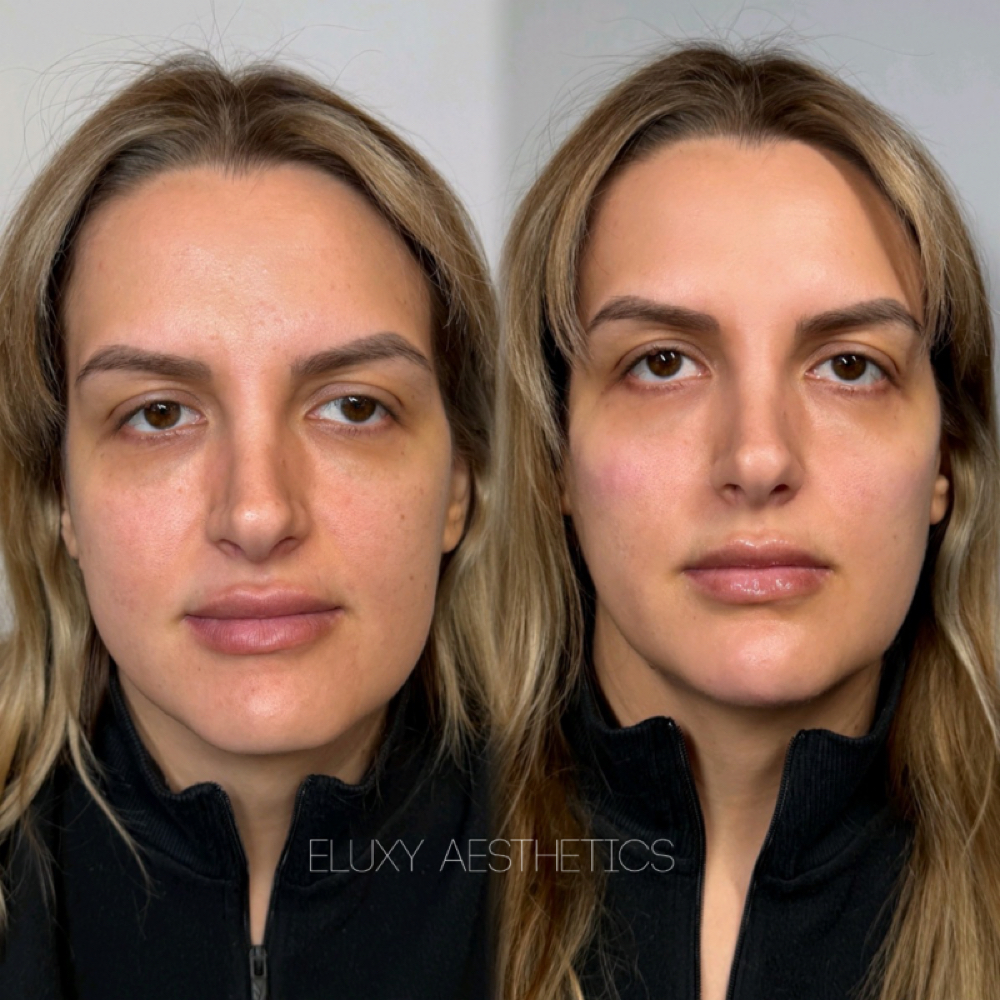 Mini Face Lift 3ML at Eluxy Aesthetics in Arlington, TX