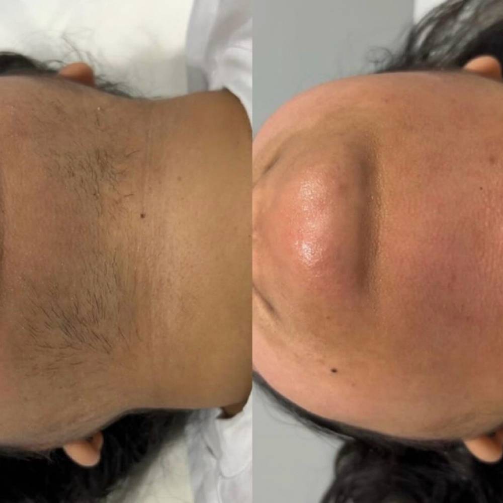 Chin/Lower Half Face Wax at Supple Wax & Skin in Kennesaw, GA