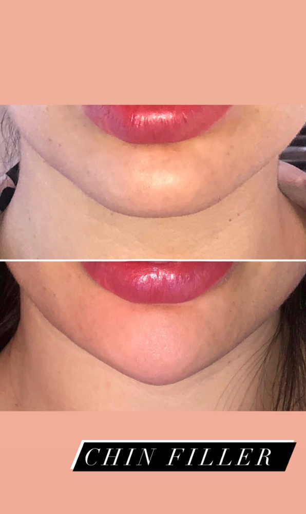 Chin Augmentation