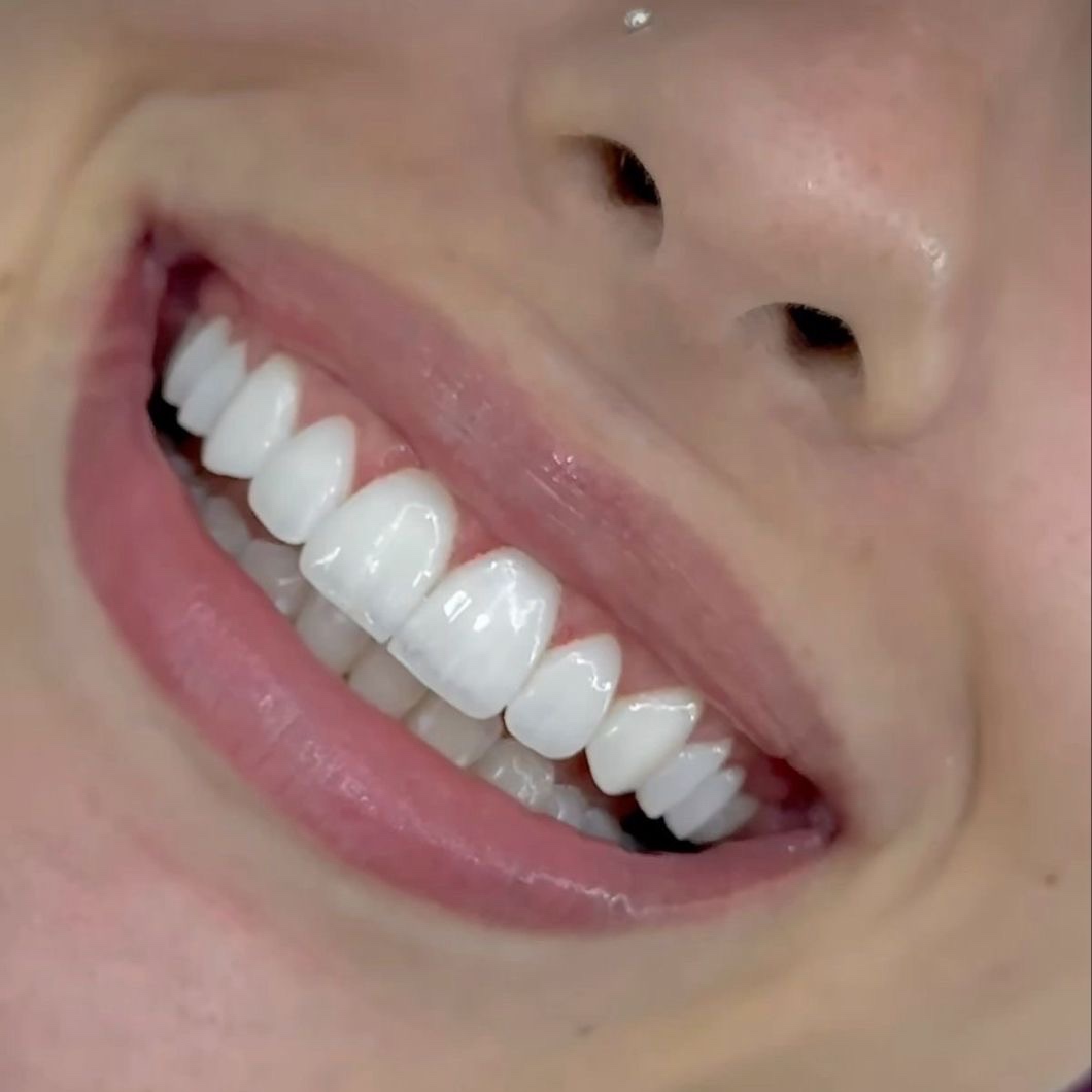 Touch up Whitening at Sparkle Smile Spa LLC in Chandler, AZ