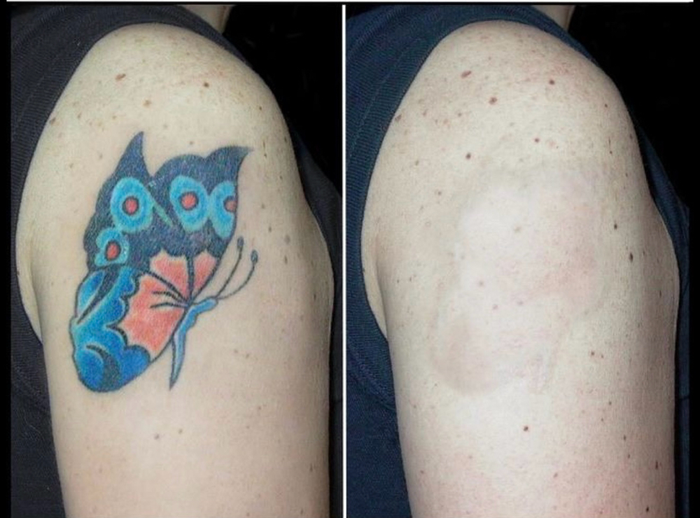 Laser Tattoo Removal