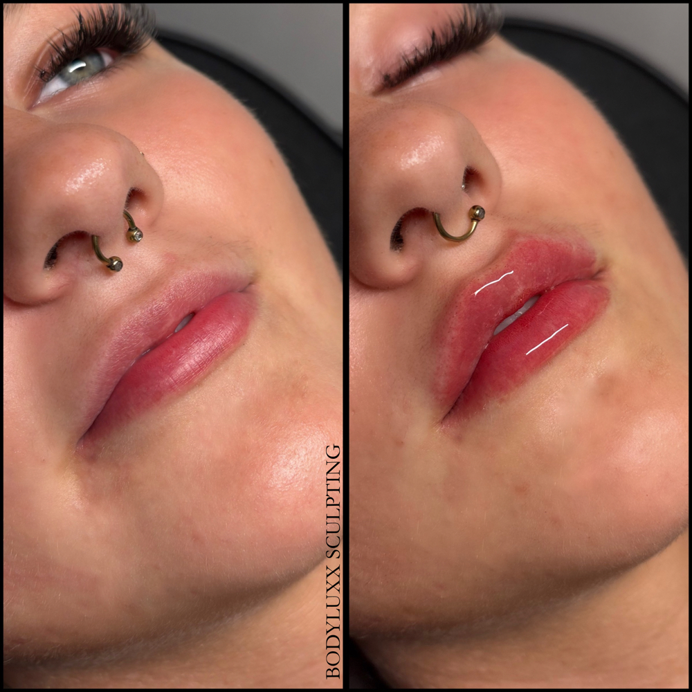 .5 ML Lip Filler (Micro Needle) at Thebodyluxxstudio in Lubbock, TX