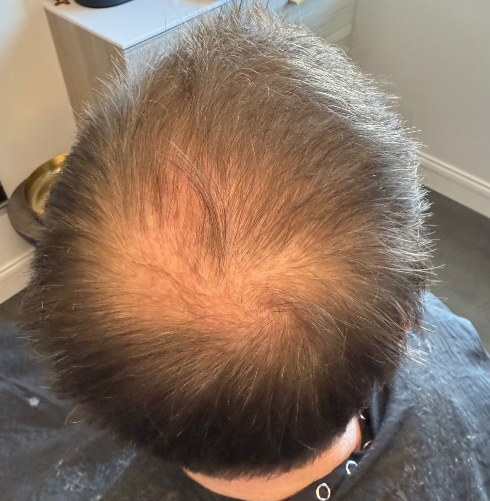 Men Hair Regeneration