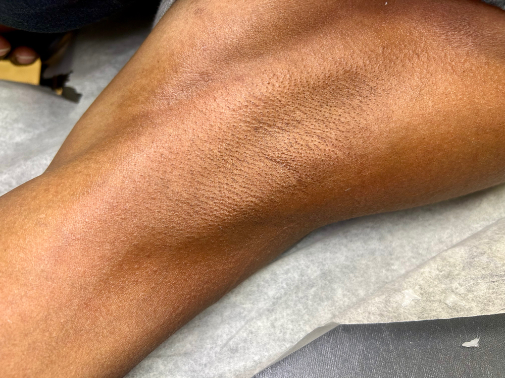 Underarms at Meekeyah Esthetix LLC in Latham, NY