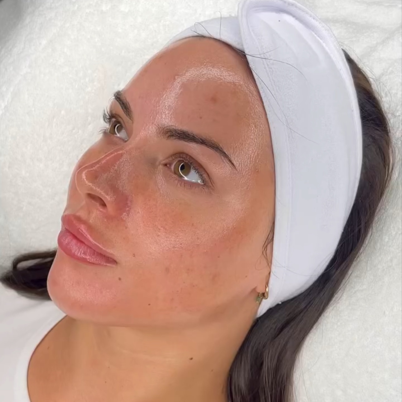 Stem Cell Microneedling at Skin Theory by WES