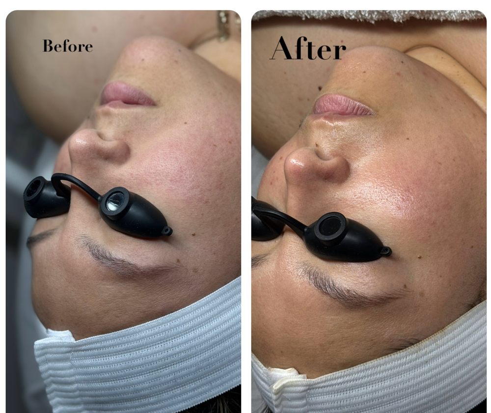 Oxygen Rx Facial