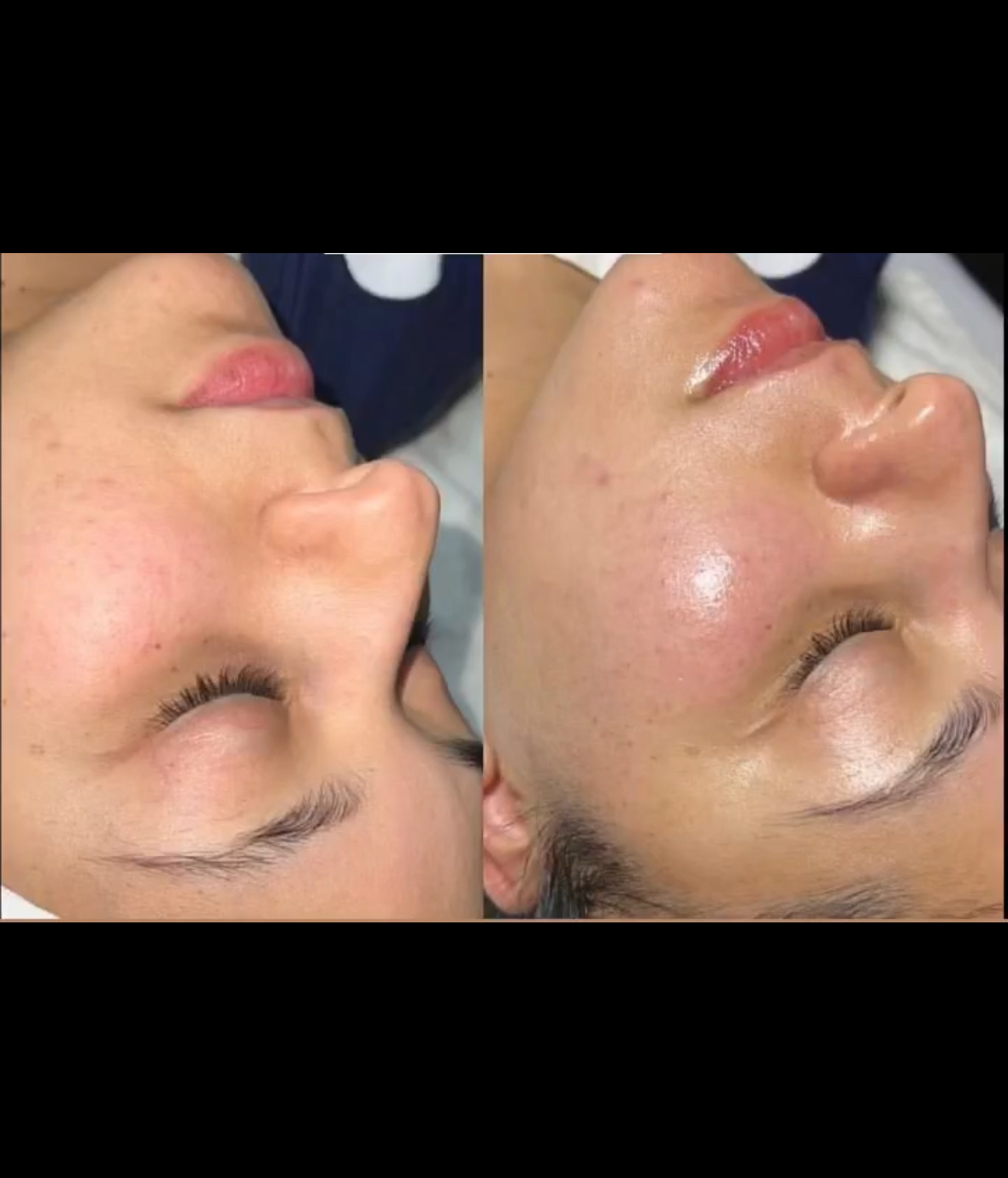 Deep Cleaning Facial