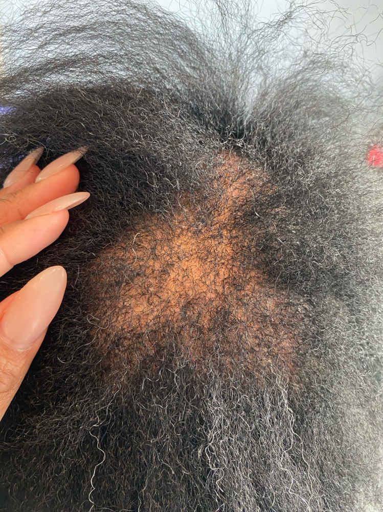 Hair Restoration Treatment