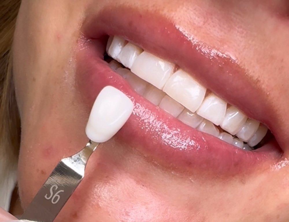 45 Min Teeth Whitening at Utopia Beauté in El Paso, TX