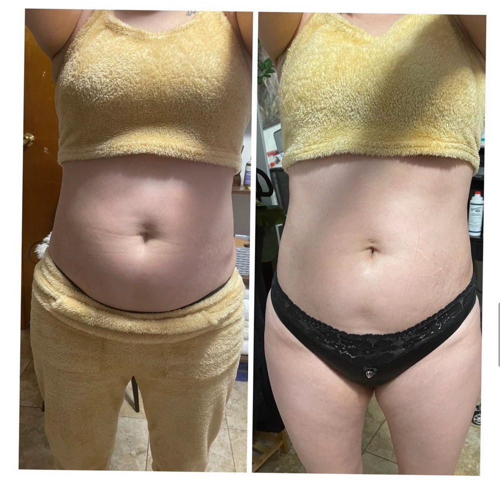 Fat Reducing Package (6) at Me Time Beauty Spa in Southbury, CT