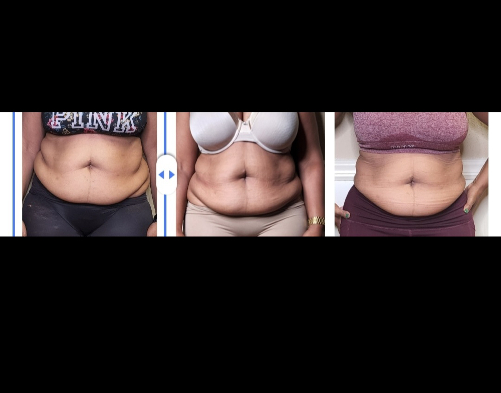 Body Sculpting Package