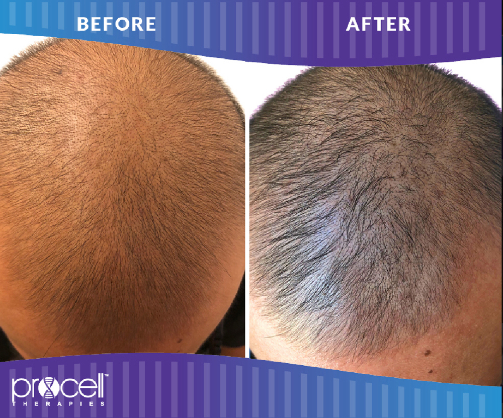 3 Hair Loss Stem Cell Therapy