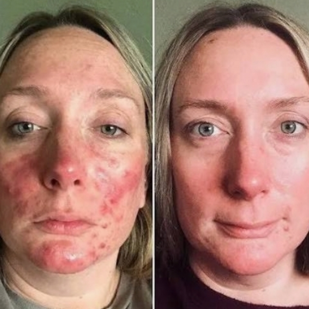 ROSAECA FACIAL at Surf City Skincare in St. Johns, FL