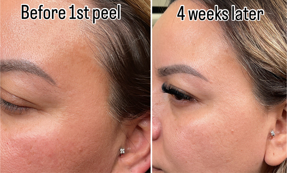 Chemical Peel at Agoddess Spa & Wellness in DeSoto, TX
