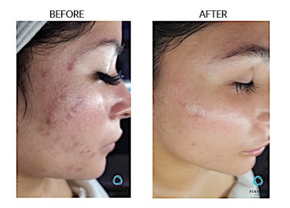 Chemical Peel
