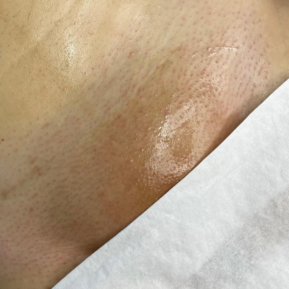 Vagacial Peel