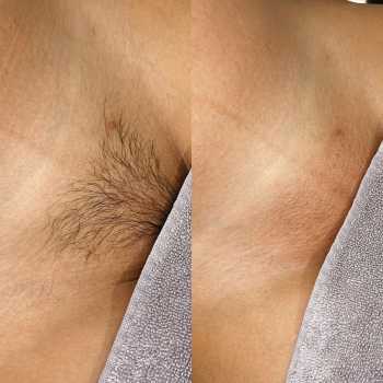 Waxing - Brazilian Pro
